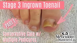 How to Pedicure Stage 3 Ingrown Big Toe with Granulation Tissue [upl. by Ahsea529]