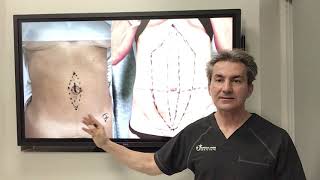 What are the different techniques for repairing the diastasis recti by Dr Iraniha [upl. by Ittocs]