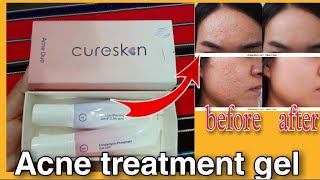 Benzoyl Peroxide Clindamycin Phosphate Gel Uses Benefits How to use  Cureskin Acne Duo [upl. by Jaquiss865]