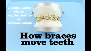 How braces move teeth timelapse  Braces Explained [upl. by Mahseh]