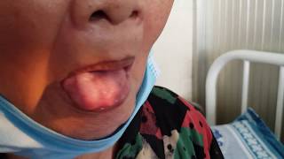 Tongue Fasciculation  ALS [upl. by Ahsok]