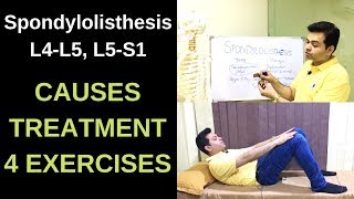 Spondylolisthesis L4L5 L5S1 Spondylolysis Spondylolisthesis Treatment Exercises LOW BACK PAIN [upl. by Ataynik]