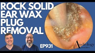 ROCK SOLID EAR WAX PLUG REMOVAL  EP931 [upl. by Acinorehs569]