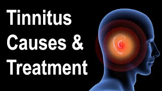 What is Tinnitus Causes amp Treatment Strategies [upl. by Aihsemek]