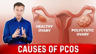 3 Causes of Polycystic Ovarian Syndrome PCOS amp High Androgens – Dr Berg [upl. by Marguerie]