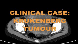 Clinical case  Metastatic cholangiocarcinoma cancer on CT abdomen  How to read and diagnose [upl. by Lorenzo952]