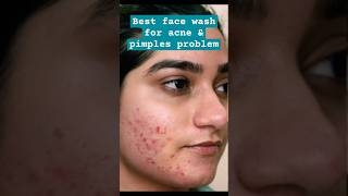 Best face wash for acne and pimples problem  acne skincare routine shorts ytshort skincare skin [upl. by Suicul]