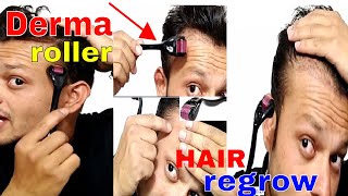 dermaroller for hair growth in hindi  hair fall solution [upl. by Leahey]