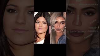 Kylie Jenners plactic surgeries celebrities kyliejenner kendalljenner [upl. by Yelram]