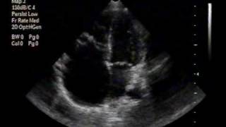 echocardiogramEbstein anomaly apical 4chamber view [upl. by Risser]