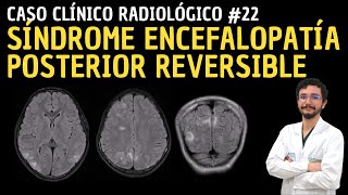 Revisión de Tema 20 Tumores astrocitarios y oligodendrogliales del Sistema Nervioso Central [upl. by Primrose]