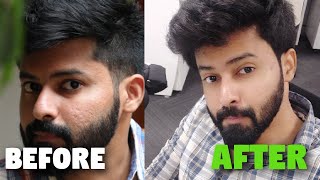 Minimise Large Pores  Acne Scars Control  முகத்தில் உள்ள பள்ளம் நீங்க இதைத்தான் செய்யனும் [upl. by Vine]