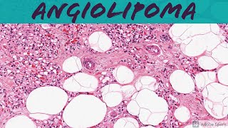 Angiolipoma 5Minute Pathology Pearls [upl. by Annadroj849]