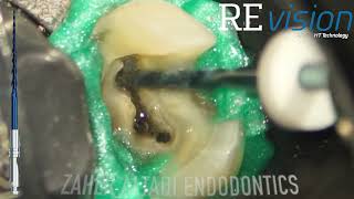 Endodontic case done by Dr Zaher AlTaqi using Endostar REvision [upl. by Lopes]