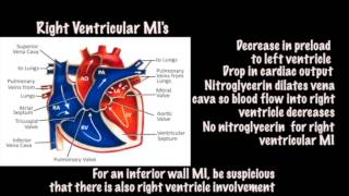 Tintinallis Emergency Medicine 8th edition video  ECG Right Ventricular MI [upl. by Anerom]