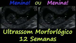 Ultrassom Morfológico 12 Semana  Menino ou Menina [upl. by Arret]