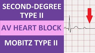 SecondDegree Type 2 Heart Block ECG Rhythm Nursing NCLEX  Mobitz Type II [upl. by Quirita]