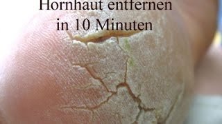 Hornhaut entfernen  Beste und schnellste Methode [upl. by Ierna]