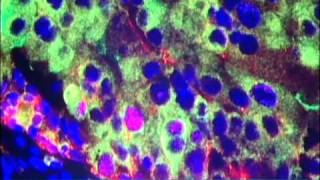 Nanoparticles for Cancer Treatment Video  Brigham and Womens Hospital [upl. by Namrej]