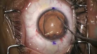 Cirugía de lente intraocular ICL para MIOPÍA y ASTIGMATISMO 🤓 [upl. by Jamnis]