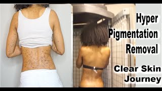 UPDATE What Happened To My SKIN  UVB Phototherapy for hyper pigmentation amp dark spots Skin Journey [upl. by Witcher512]