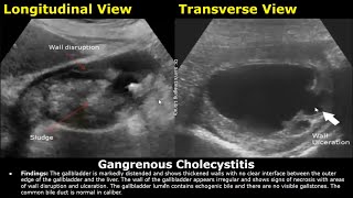 Abdominal Ultrasound Reporting  Liver Gallbladder Bile Duct Pancreas Spleen Kidney USG Reports [upl. by Pearlman183]