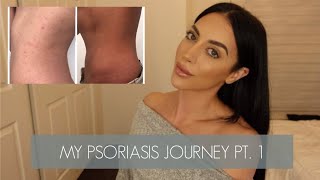 PSORIASIS JOURNEY PT 1  HOW I CLEARED MY PSORIASIS AND GOT MY LIFE BACK [upl. by Aicarg466]