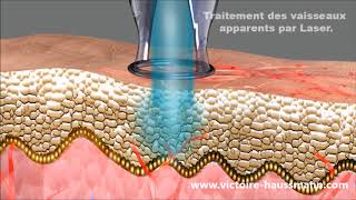 Le traitement de la couperose au laser à Paris [upl. by Allanson]