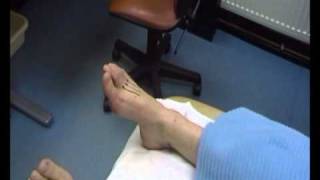 hammer toe surgery [upl. by Vories]