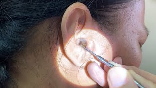 Massive Hard Dry Earwax Removed from Womans Ear [upl. by Ahtelra937]