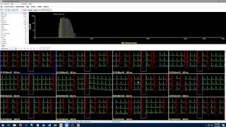 1 Introduction to Holter Analysis NEM [upl. by Grazia]