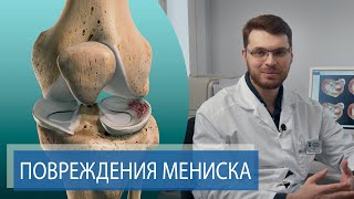 ТРАВМА МЕНИСКА  Боль и хруст в колене [upl. by Huey]