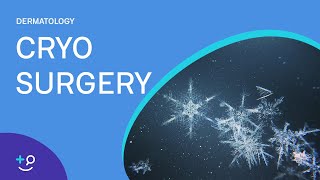 Cryo Surgery Procedure Freezing [upl. by Esina]