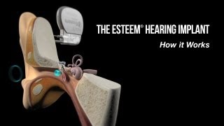 How Does the Esteem® Hearing Implant Differ From Hearing Aids [upl. by Annaihr]