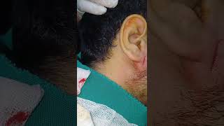 Incision and drainge of absces inferior to rt ear lobule entdoctor [upl. by Ennael560]