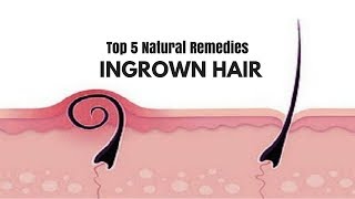 Get Rid of Ingrown Hair  Natural Home Remedies for Ingrown Hair Removal [upl. by Dyane657]