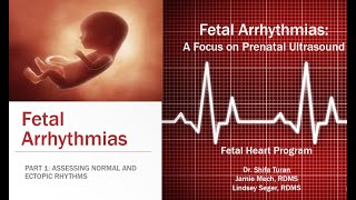 FETAL ARRHYTHMIAS Part One  Assessing Normal and Ectopic Rhythms [upl. by Carmena]