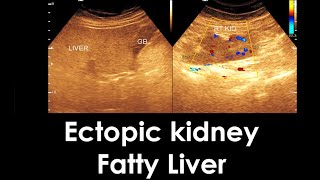 Practical case  Ectopic kidney  Fatty infiltration of the Liver  Ovarian cyst [upl. by Adnahsal]