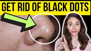 HOW TO GET RID OF BLACK DOTS ON THE NOSE  Dermatologist [upl. by Melinde993]