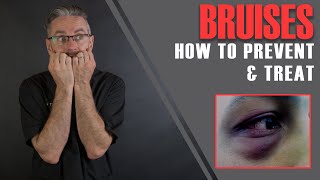 FILLER BRUISES Dr Tims 16 Essential Tips To Prevent amp Minimise Bruises Aesthetics Mastery Show [upl. by Thagard]