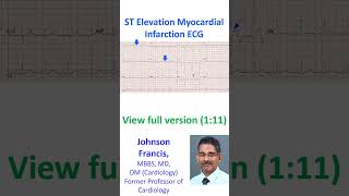 ST Elevation Myocardial Infarction ECG [upl. by Attekal]