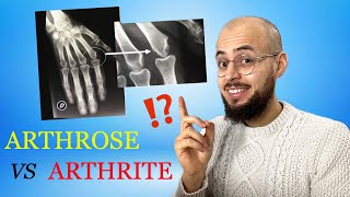 Arthrose et arthrite  les différences causes symptômes traitements [upl. by Cimbura]