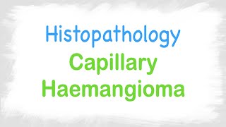 Capillary Haemangioma histopathology features [upl. by Nirrol926]