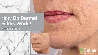 How do dermal fillers work [upl. by Eseyt]