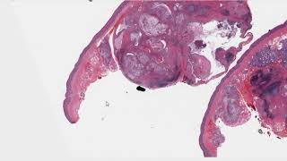 Salivary Gland Tumor Mucoepidermoid Carcinoma Micro Tips [upl. by Mehala615]