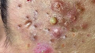 Blackhead Removal With Sac Dep Spa 110107 [upl. by Ghassan]