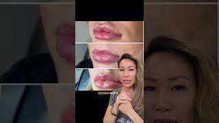 Got lip filler migration Heres what to do medspa beyoutymedspa skincare kyliejennerchallenge [upl. by Teddie]