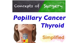 Thyroid papillary cancer Most Simplified Approach to Management [upl. by Assirek]