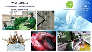 What is Unilateral Biportal Endoscopic UBE Spine Surgery English version [upl. by Thurston]