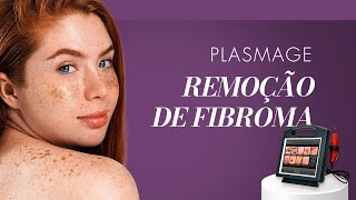 PLASMAGE  Remoção de Fibroma no Couro Cabeludo [upl. by Jacki389]